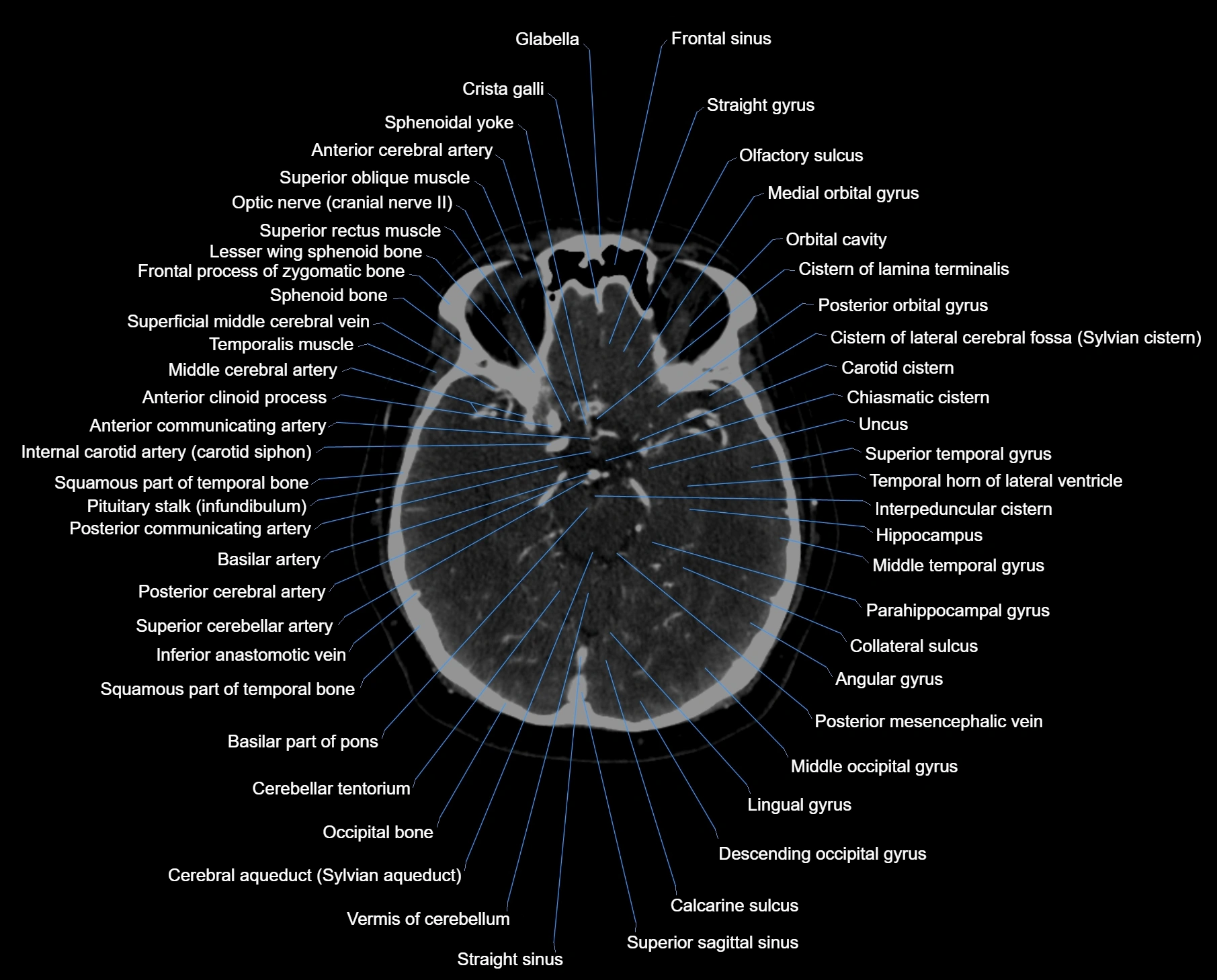 CT scan brain axial labelled cross sectional anatomy image-img-000027.webp